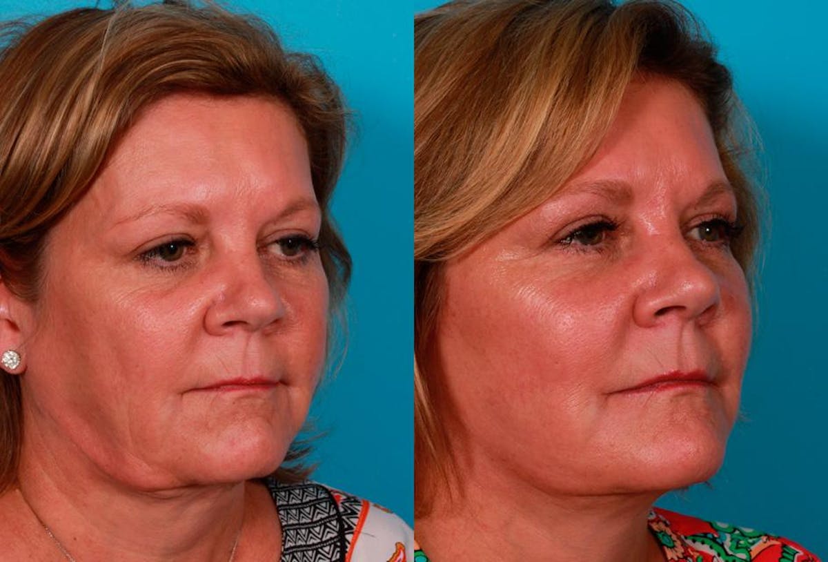 Limited Incision Facelift Before & After Gallery - Patient 221496 - Image 2