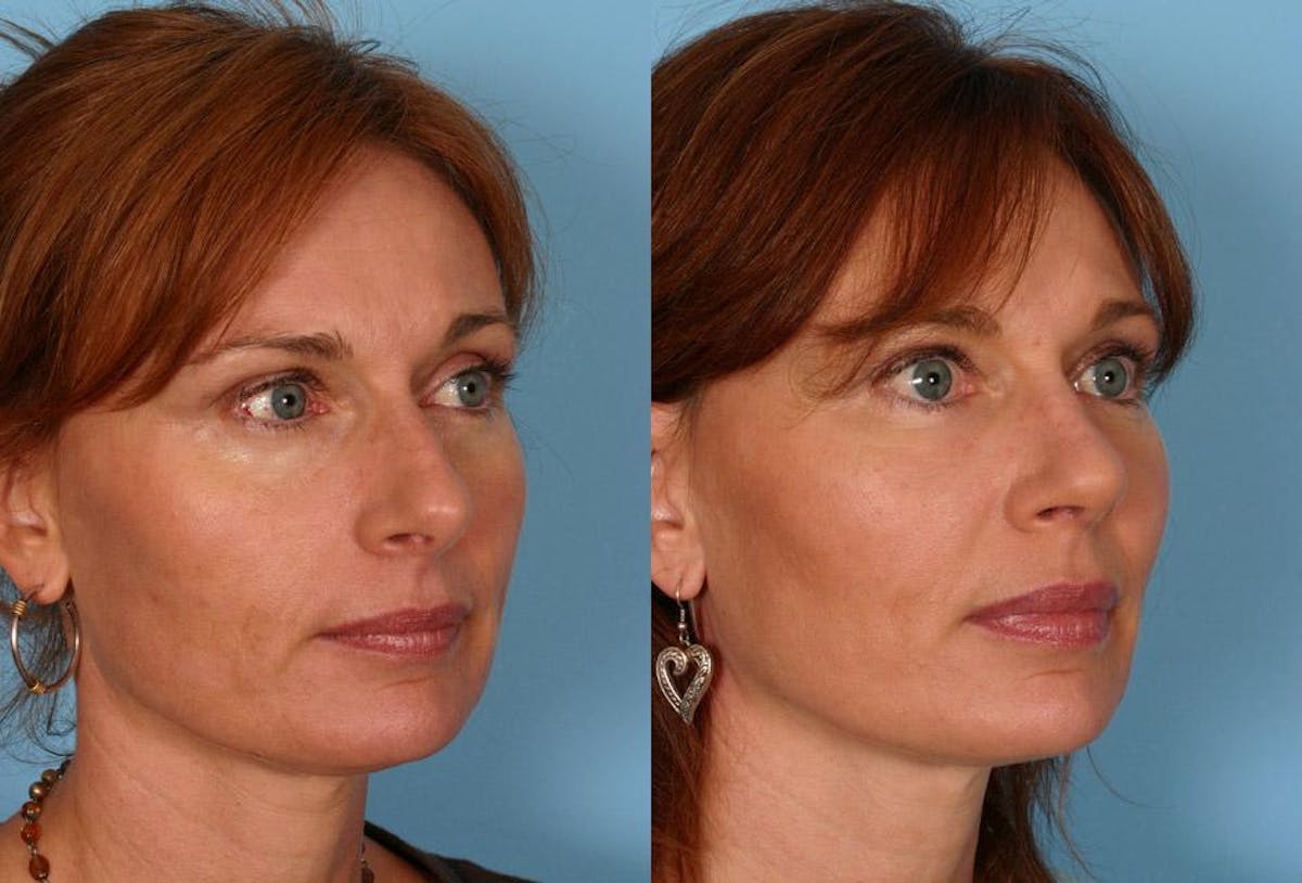 Facial Fat Transfer Before & After Gallery - Patient 704361 - Image 2