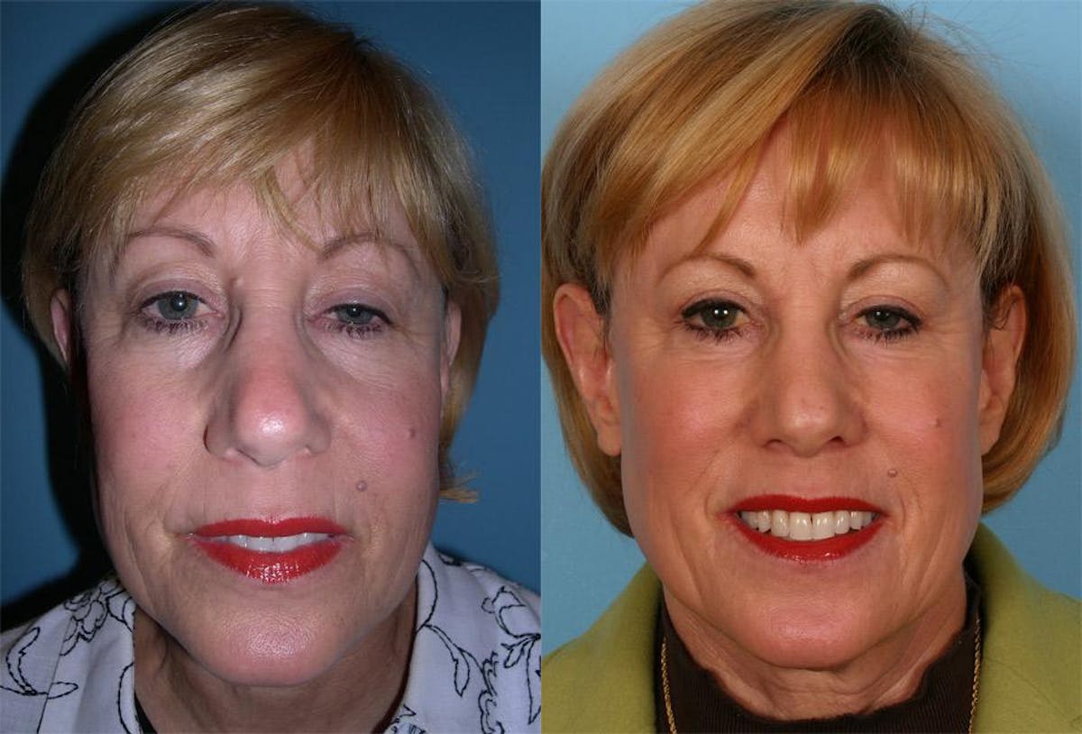 Eyelid Surgery (Blepharoplasty) Before & After Gallery - Patient 333526 - Image 1