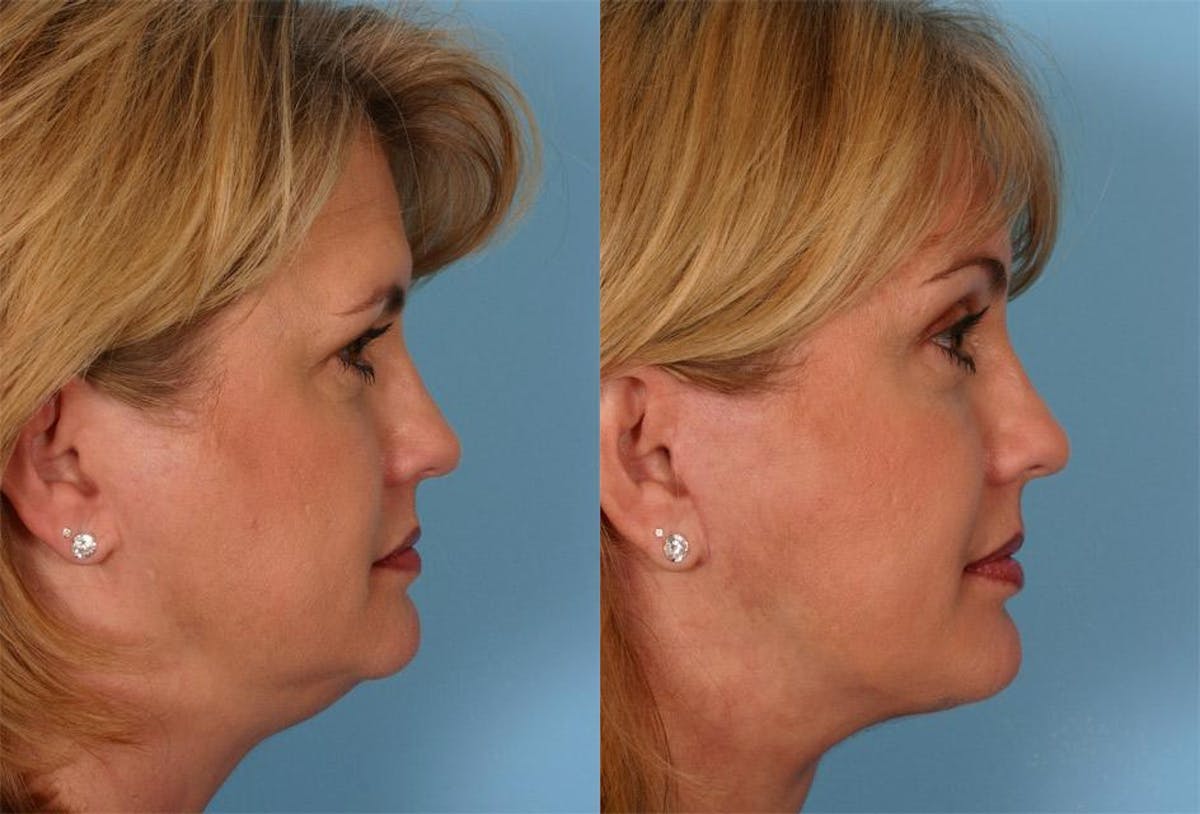 Facelift Before & After Gallery - Patient 264697 - Image 3