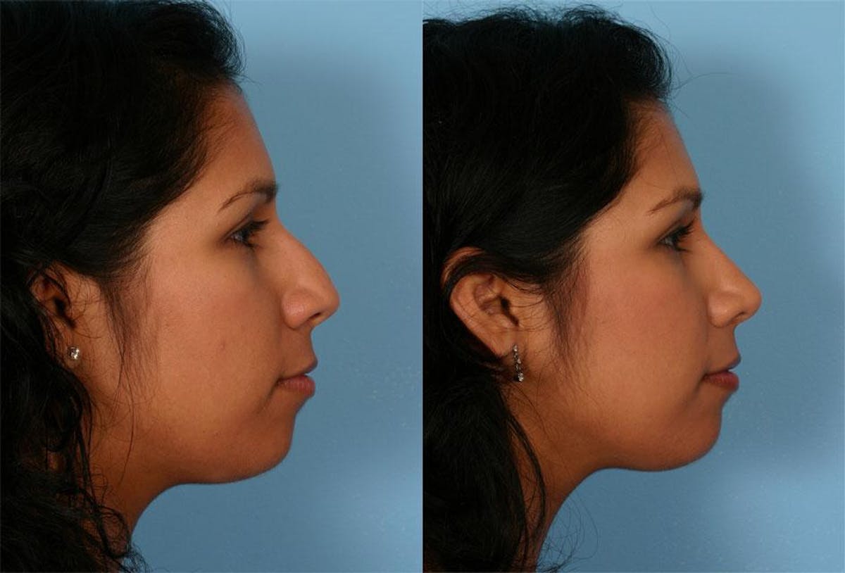 Rhinoplasty Before & After Gallery - Patient 141314 - Image 2