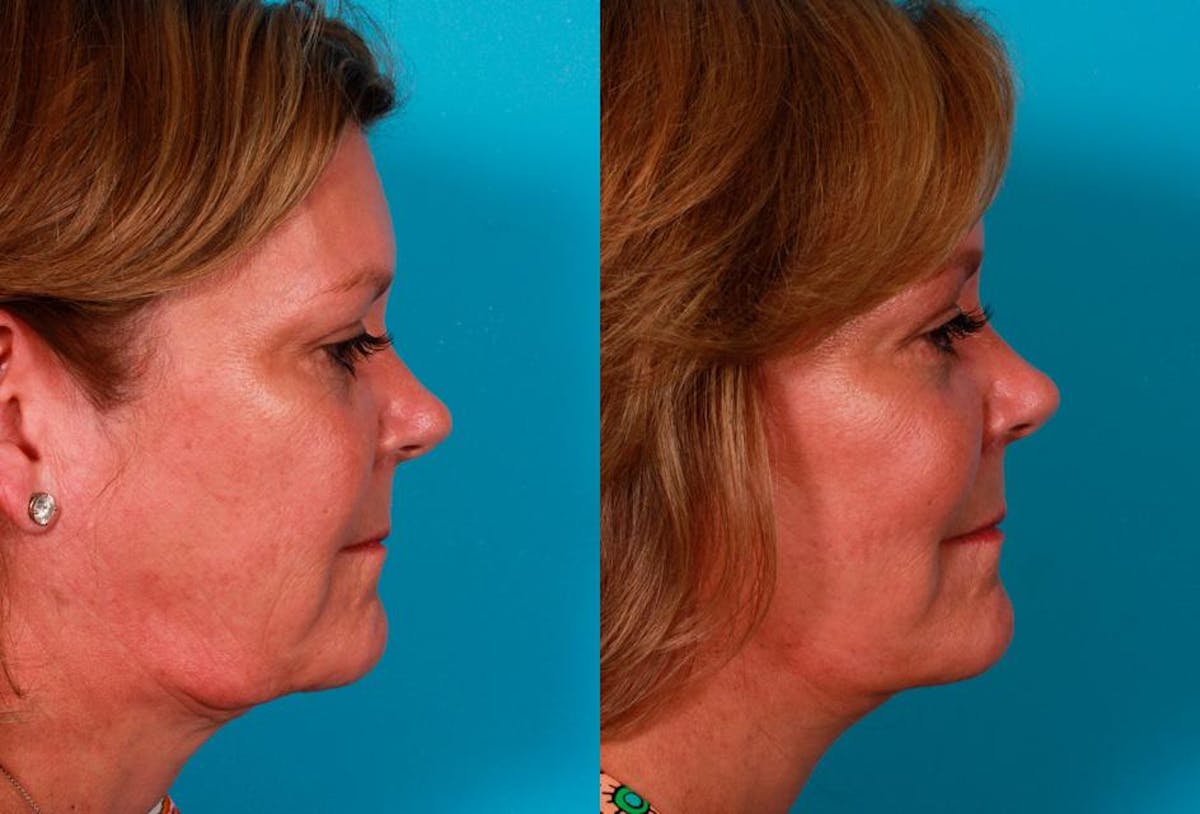 Limited Incision Facelift Before & After Gallery - Patient 221496 - Image 3