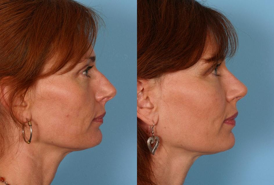 Facial Fat Transfer Before & After Gallery - Patient 704361 - Image 3