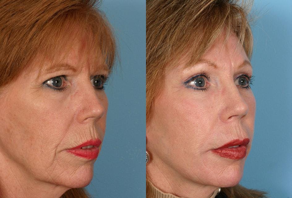 Endoscopic Brow Lift Before & After Gallery - Patient 365199 - Image 2