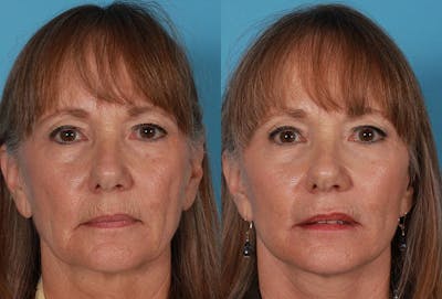 Limited Incision Facelift Before & After Gallery - Patient 227132 - Image 1