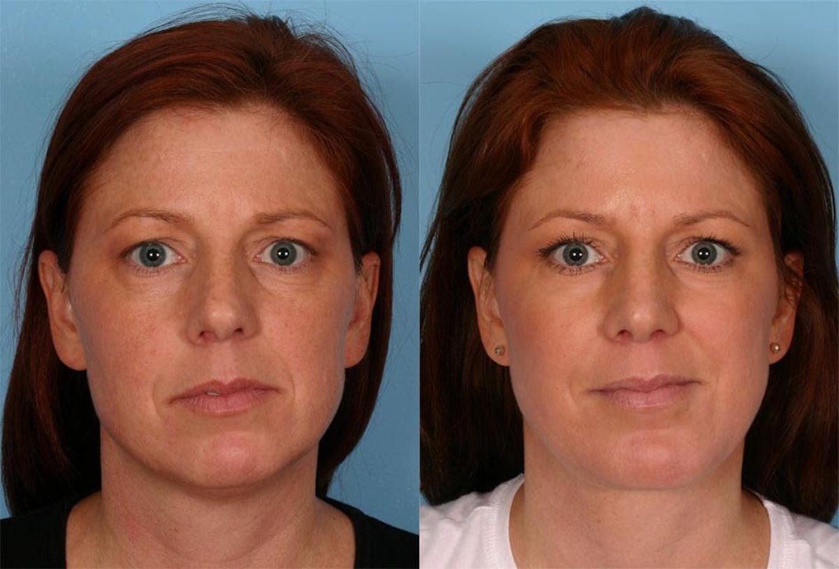 Rhinoplasty Before & After Gallery - Patient 187096 - Image 1