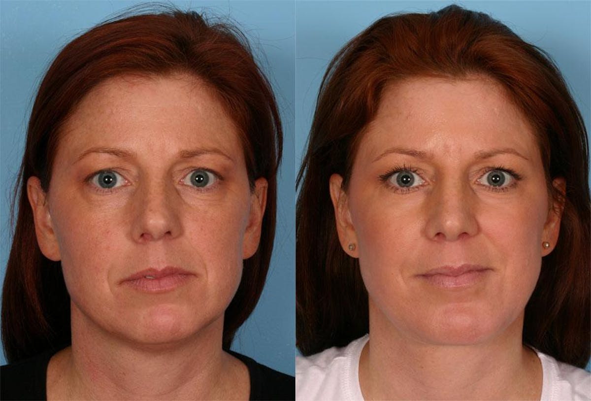 Rhinoplasty Before & After Gallery - Patient 187096 - Image 1