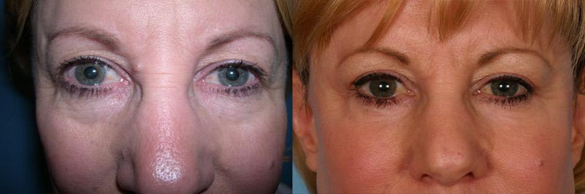 Eyelid Surgery (Blepharoplasty) Before & After Gallery - Patient 333526 - Image 3
