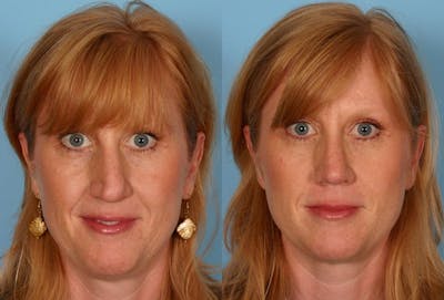 Nasal Obstruction Before & After Gallery - Patient 419717 - Image 1