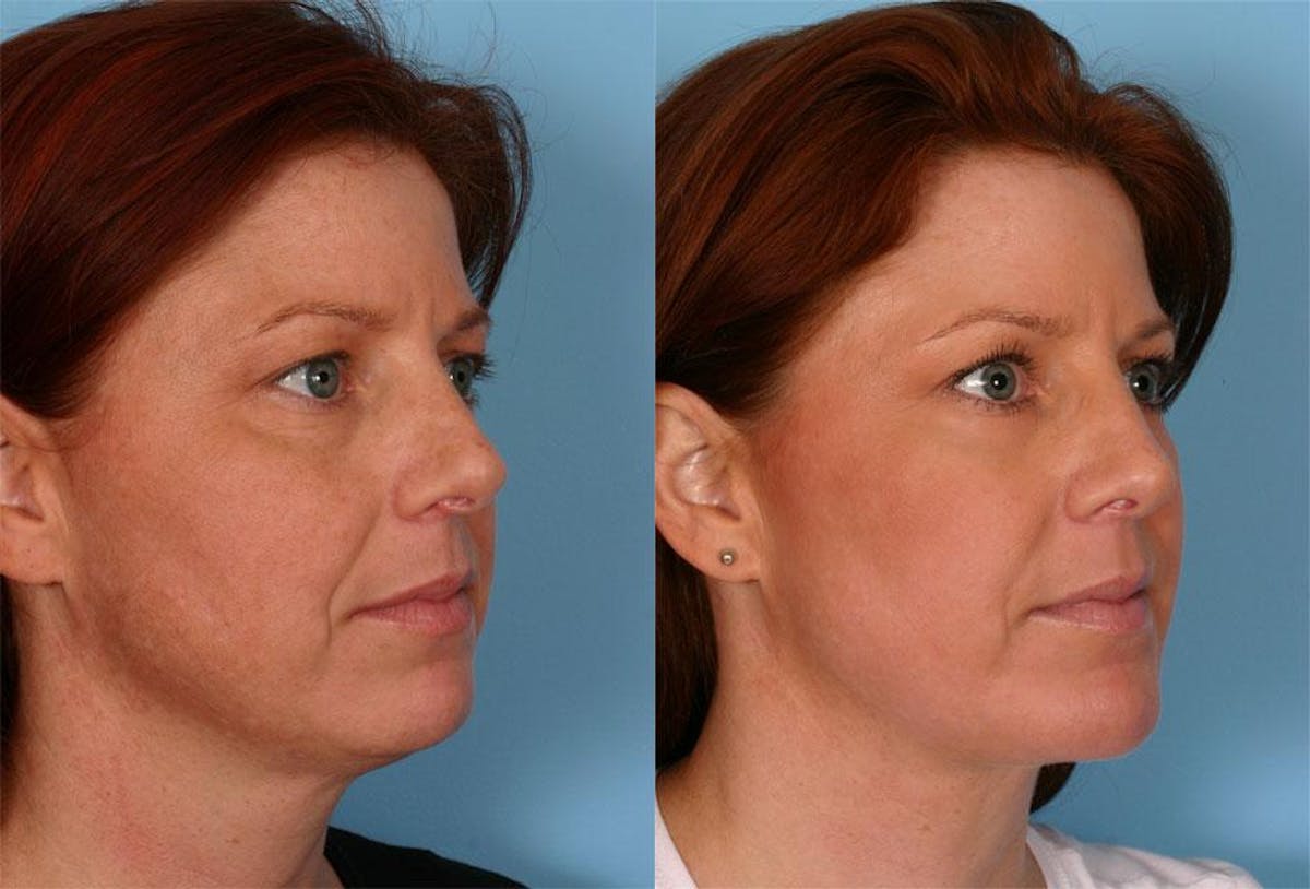 Rhinoplasty Before & After Gallery - Patient 187096 - Image 2
