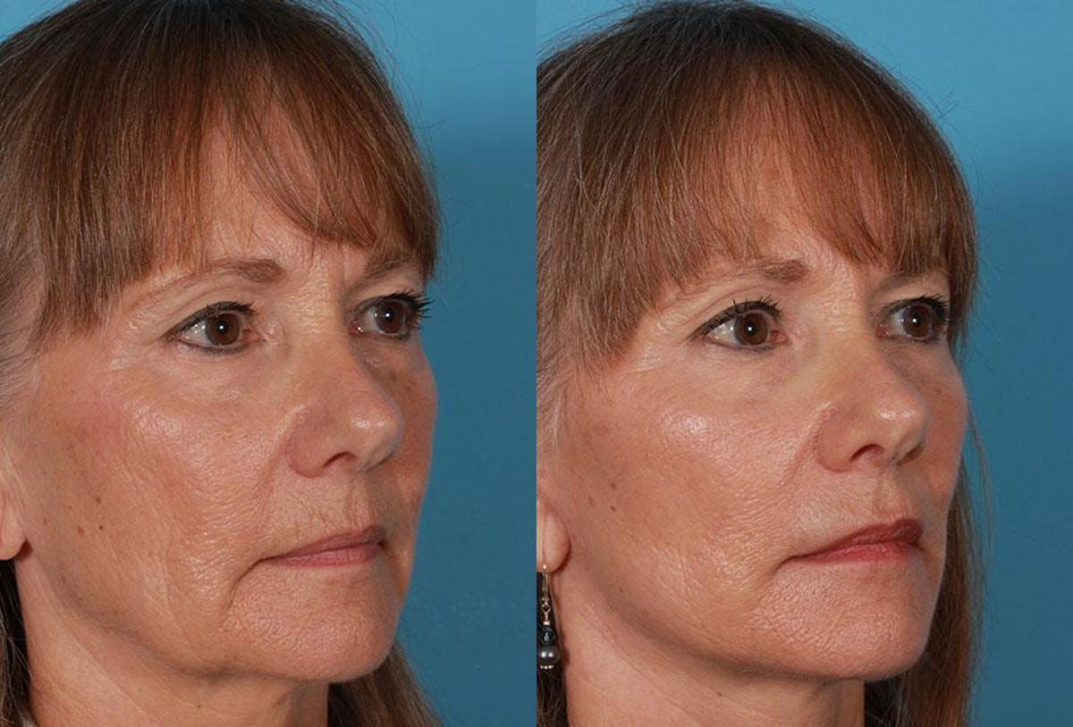 Limited Incision Facelift Before & After Gallery - Patient 227132 - Image 2
