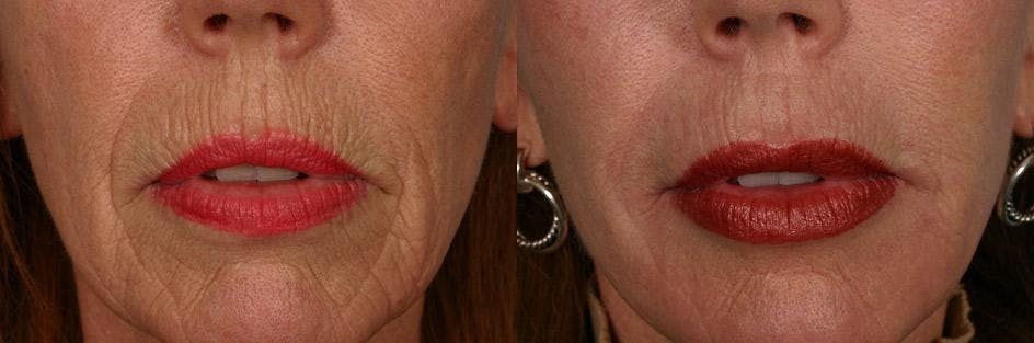 Endoscopic Brow Lift Before & After Gallery - Patient 365199 - Image 4