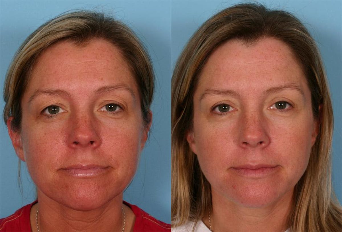 Eyelid Surgery (Blepharoplasty) Before & After Gallery - Patient 758762 - Image 1