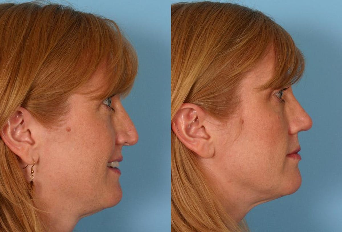 Nasal Obstruction Before & After Gallery - Patient 419717 - Image 2