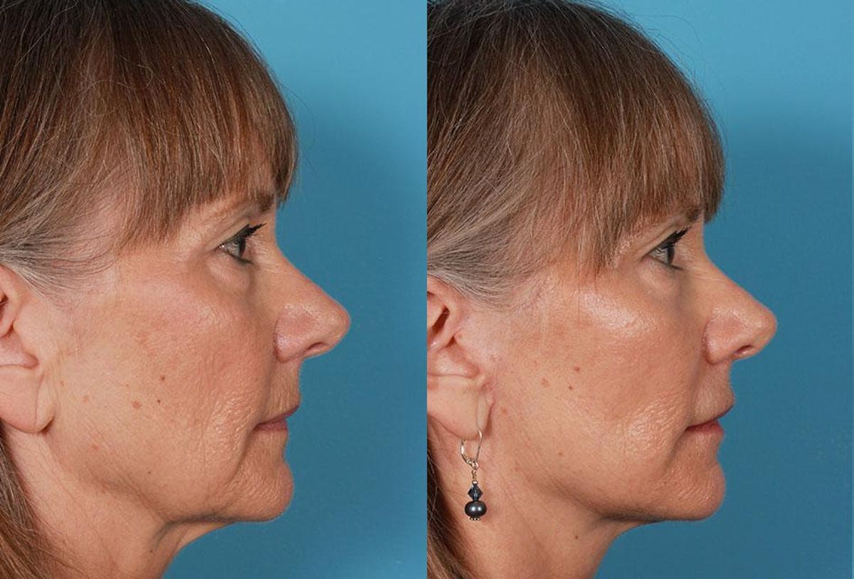 Limited Incision Facelift Before & After Gallery - Patient 227132 - Image 3