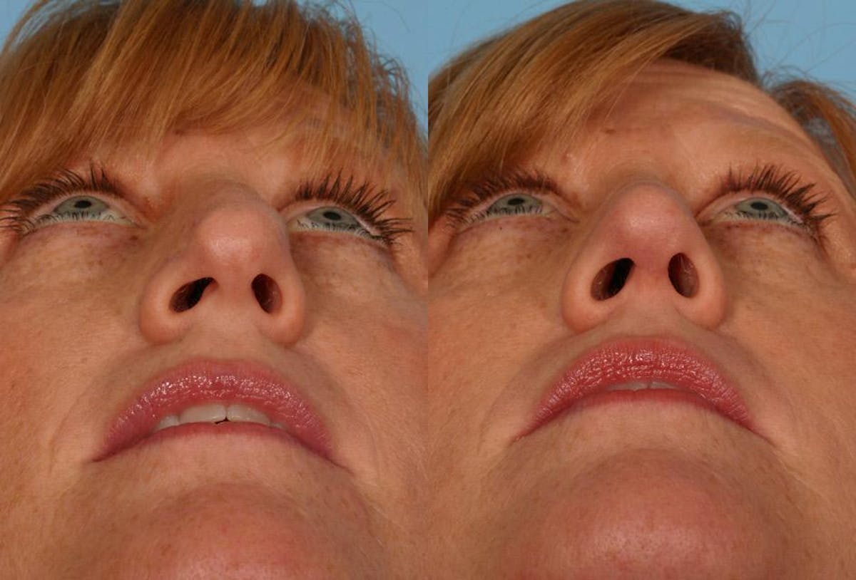 Nasal Obstruction Before & After Gallery - Patient 419717 - Image 3