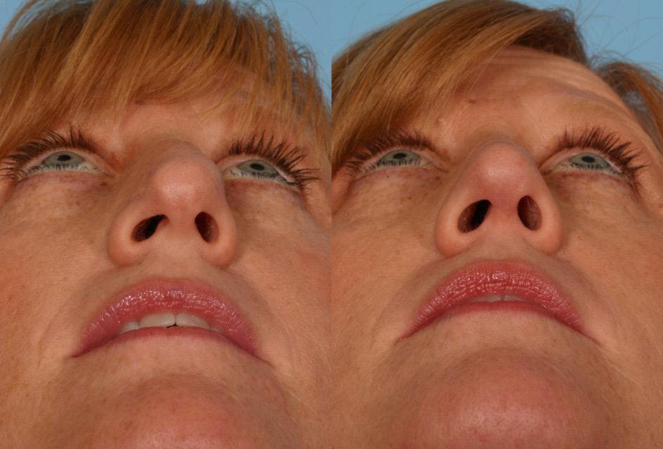 Nasal Obstruction Before & After Gallery - Patient 419717 - Image 3