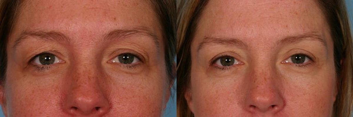 Eyelid Surgery (Blepharoplasty) Before & After Gallery - Patient 758762 - Image 2
