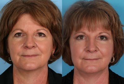 Endoscoplic Browlift Before & After Gallery - Patient 123626 - Image 1