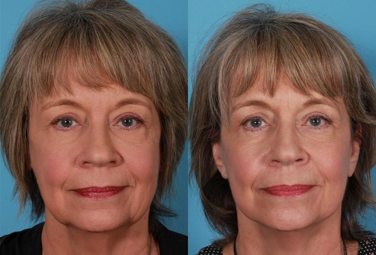 Limited Incision Facelift Before & After Gallery - Patient 742197 - Image 1