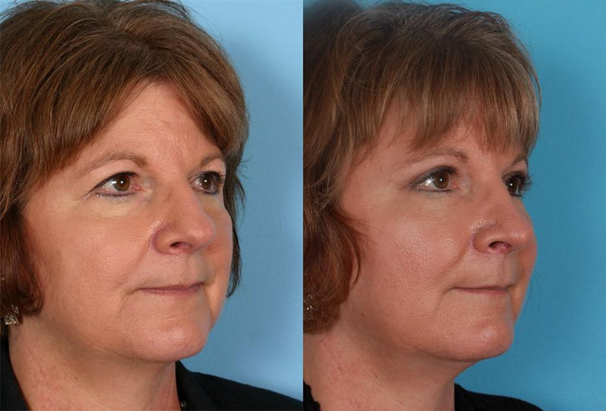 Endoscoplic Browlift Before & After Gallery - Patient 123626 - Image 2