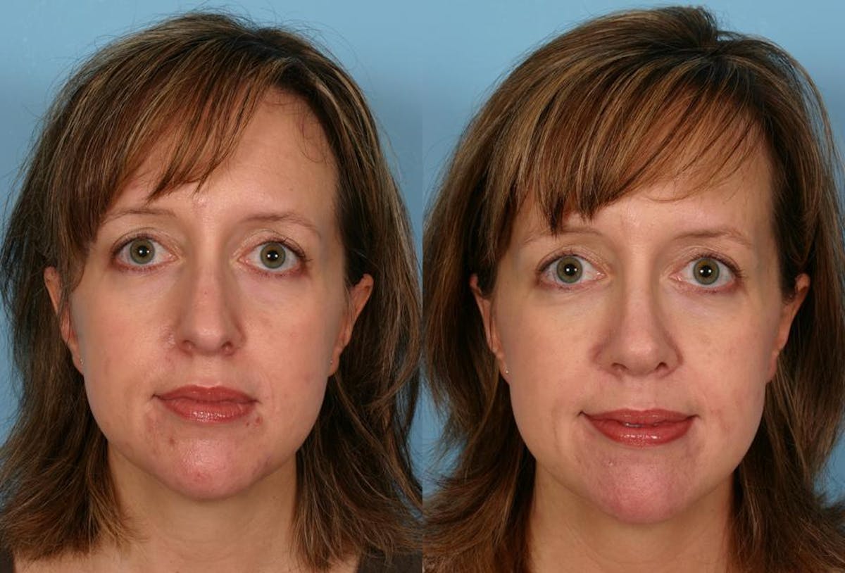 Rhinoplasty Before & After Gallery - Patient 322529 - Image 1