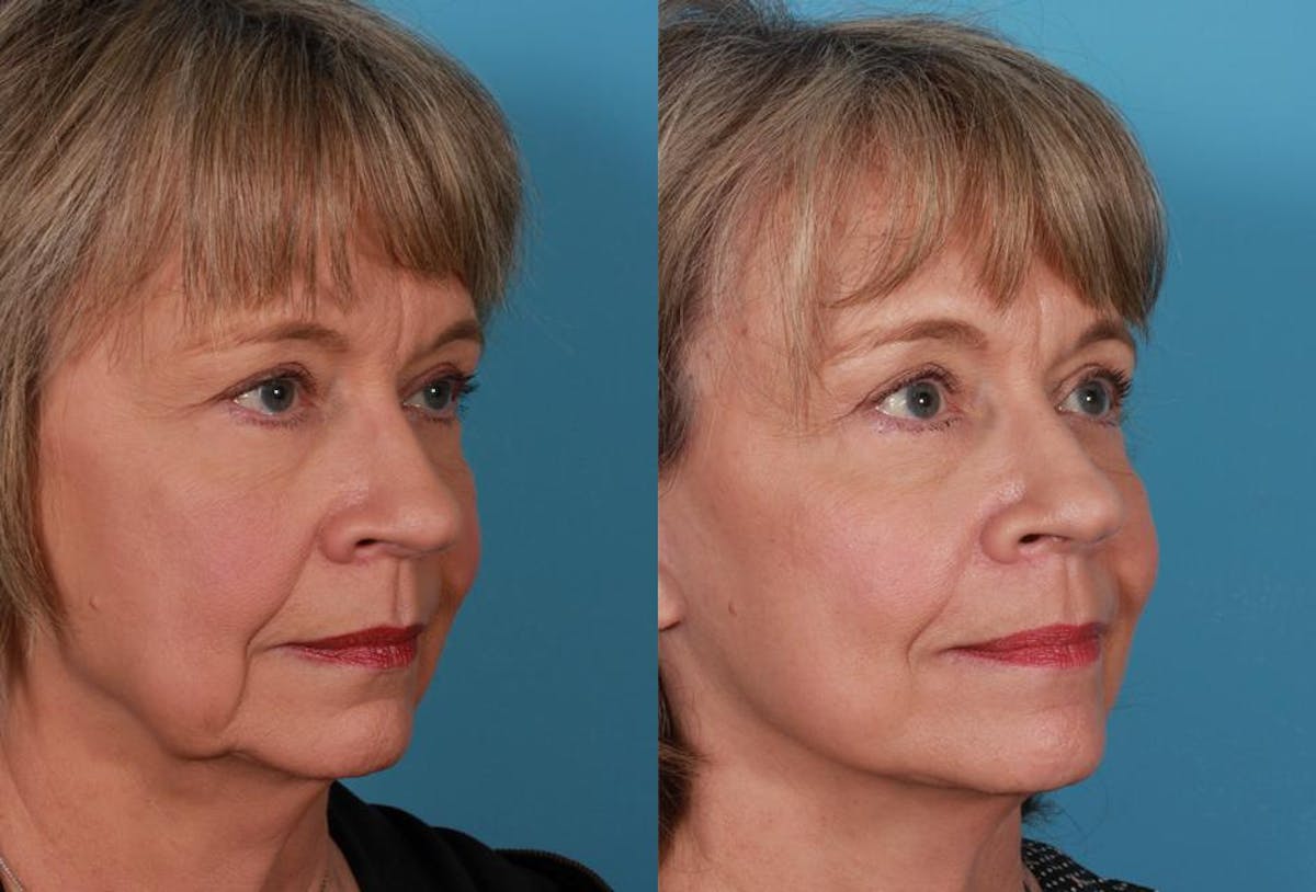 Limited Incision Facelift Before & After Gallery - Patient 742197 - Image 2
