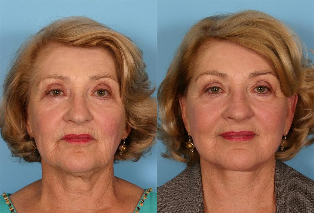 Facelift Before & After Gallery - Patient 731368 - Image 1