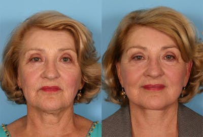 Facelift Before & After Gallery - Patient 731368 - Image 1