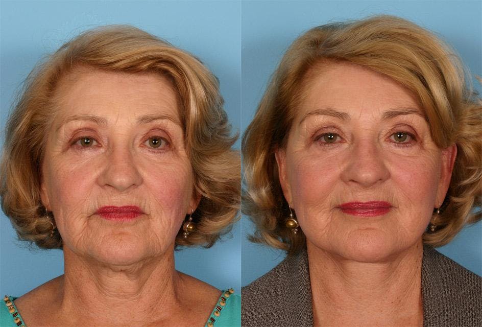 Facelift Before & After Gallery - Patient 731368 - Image 1
