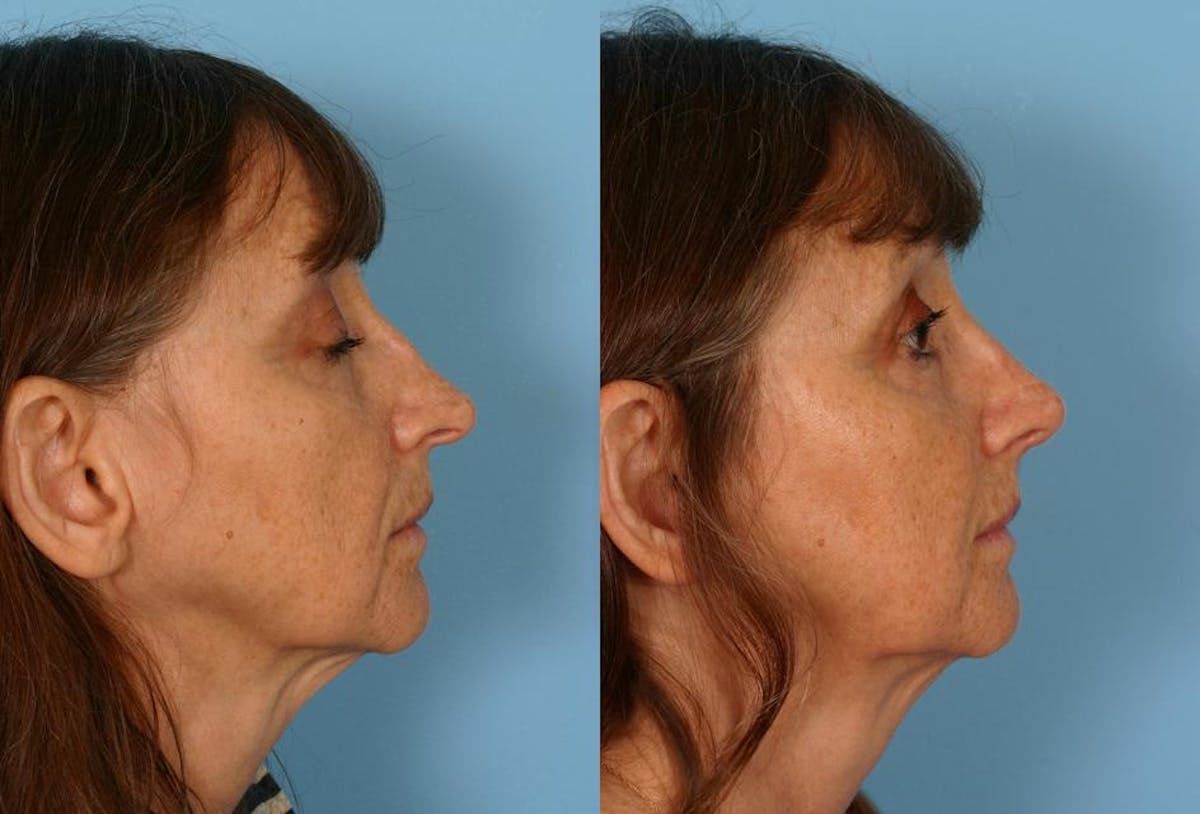 Nasal Obstruction Before & After Gallery - Patient 377226 - Image 2