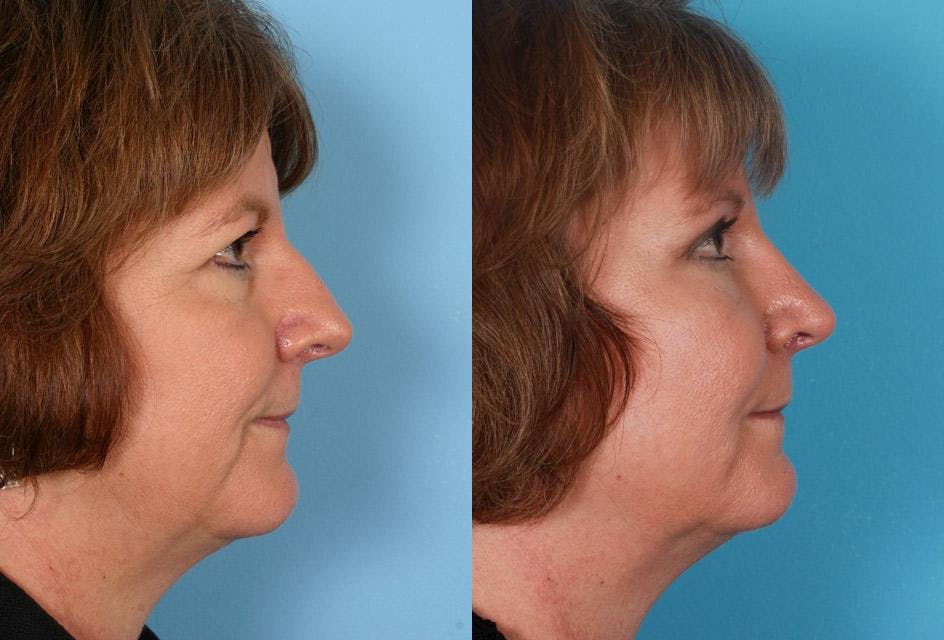 Endoscopic Brow Lift Before & After Gallery - Patient 123626 - Image 3