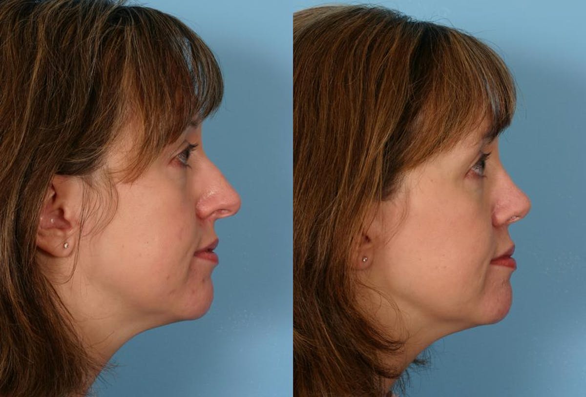 Rhinoplasty Before & After Gallery - Patient 322529 - Image 2
