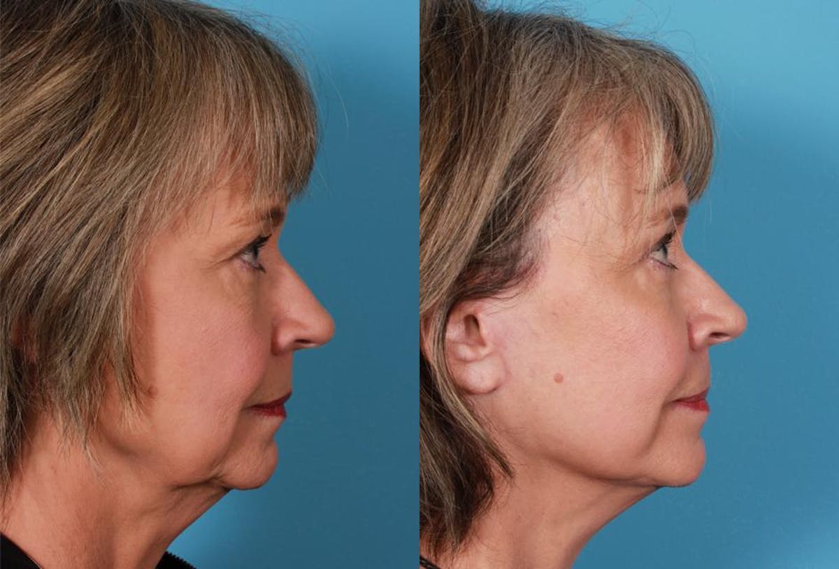 Limited Incision Facelift Before & After Gallery - Patient 742197 - Image 3
