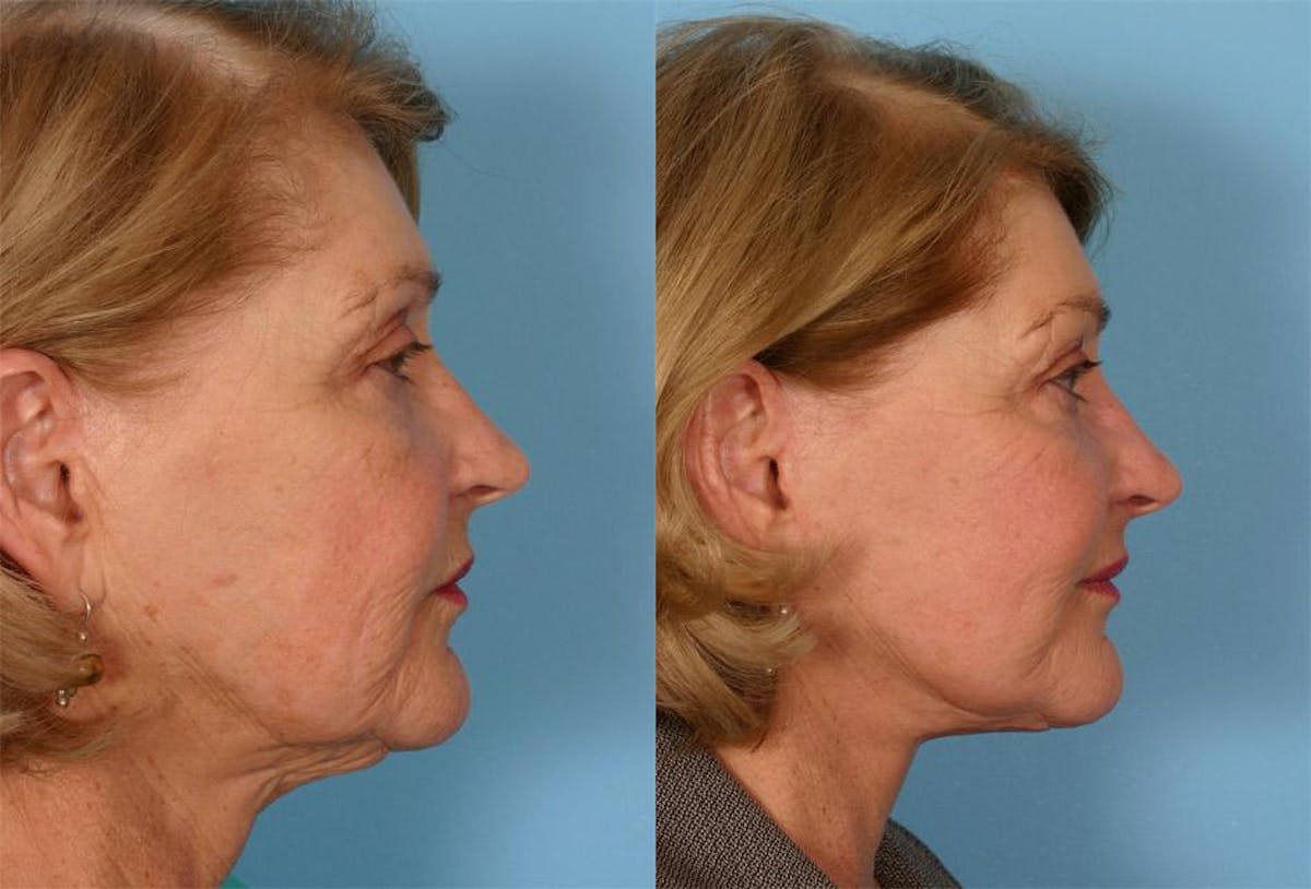 Facelift Before & After Gallery - Patient 731368 - Image 2