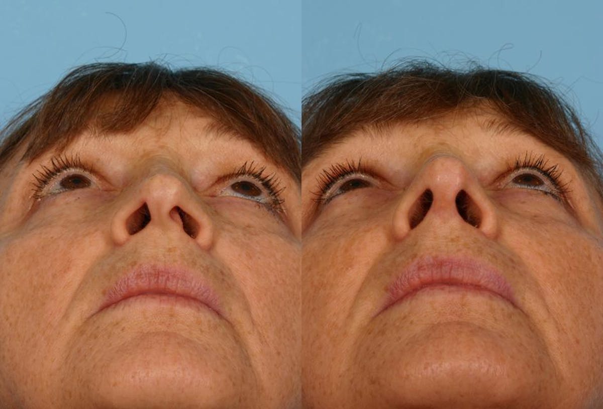 Nasal Obstruction Before & After Gallery - Patient 377226 - Image 3
