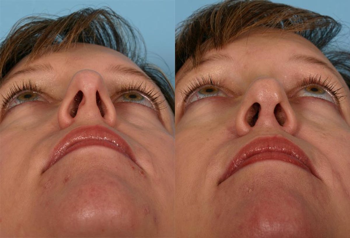 Rhinoplasty Before & After Gallery - Patient 322529 - Image 3
