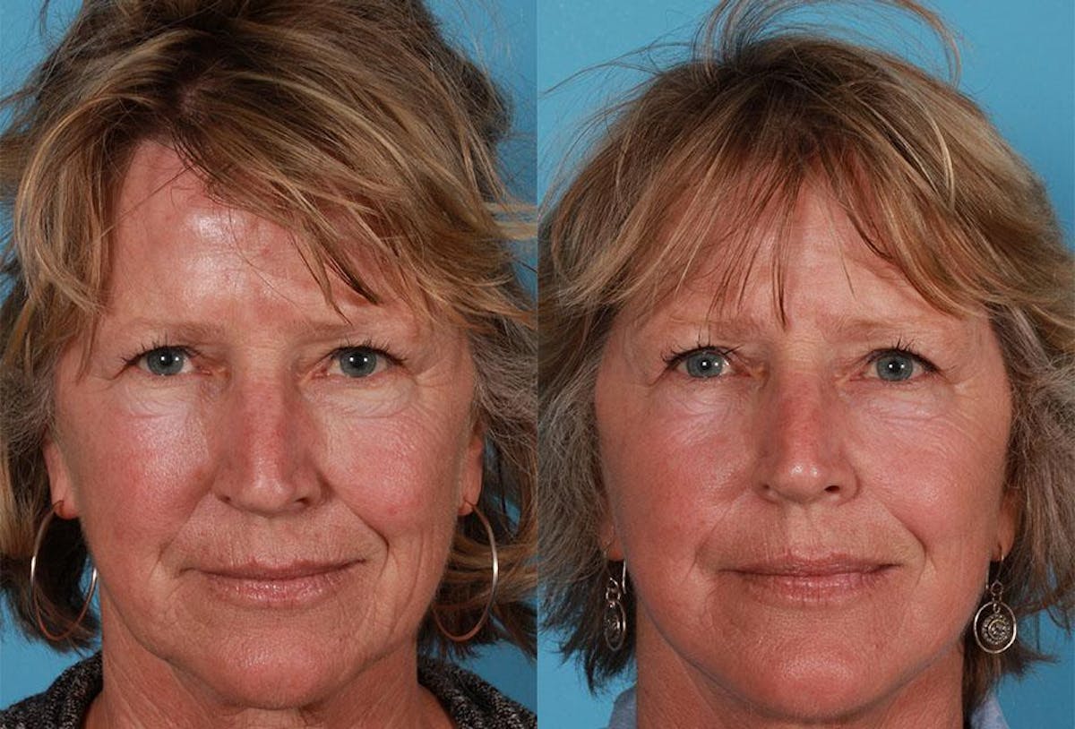 Limited Incision Facelift Before & After Gallery - Patient 130114 - Image 1
