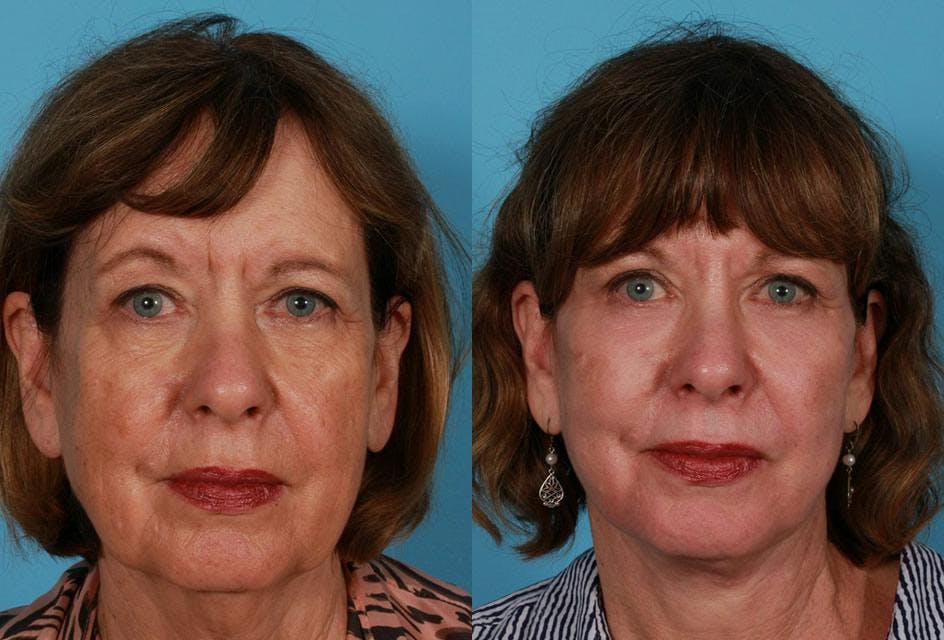 Endoscopic Brow Lift Before & After Gallery - Patient 121856 - Image 1