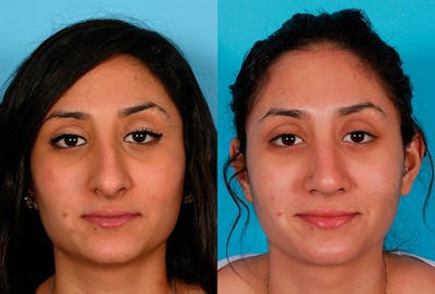 Rhinoplasty Before & After Gallery - Patient 414918 - Image 1
