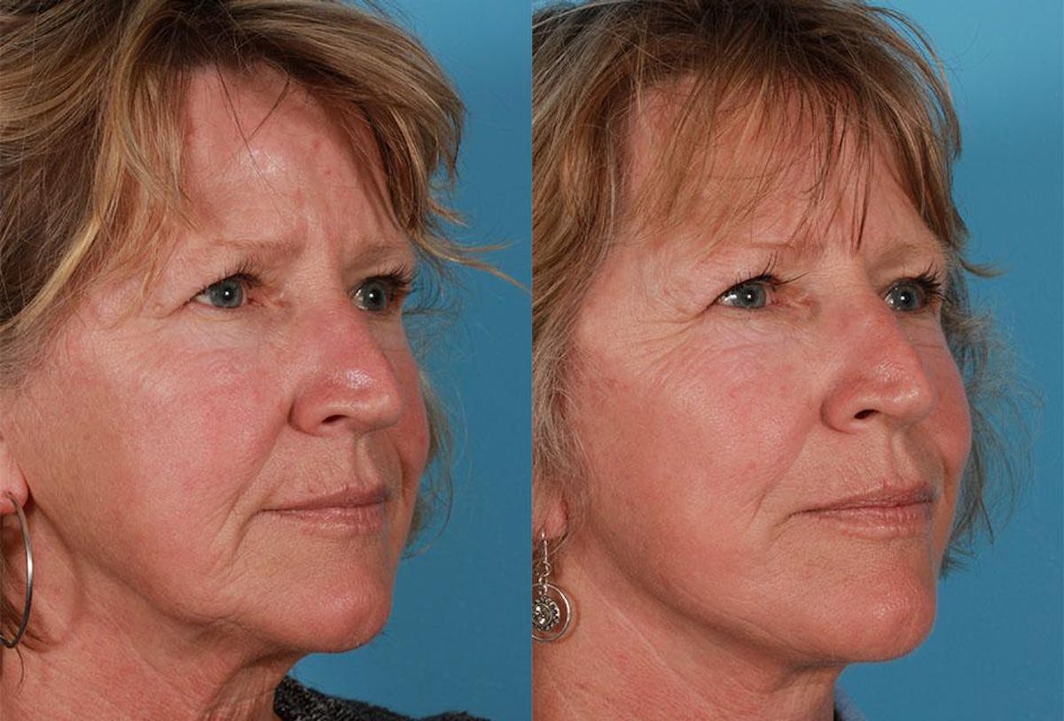Limited Incision Facelift Before & After Gallery - Patient 130114 - Image 2