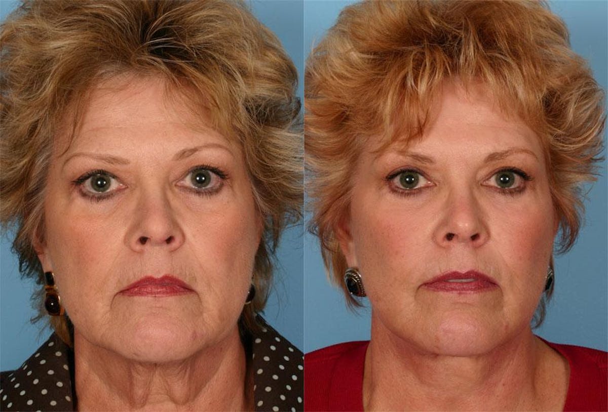 Facial Fat Transfer Before & After Gallery - Patient 408084 - Image 1