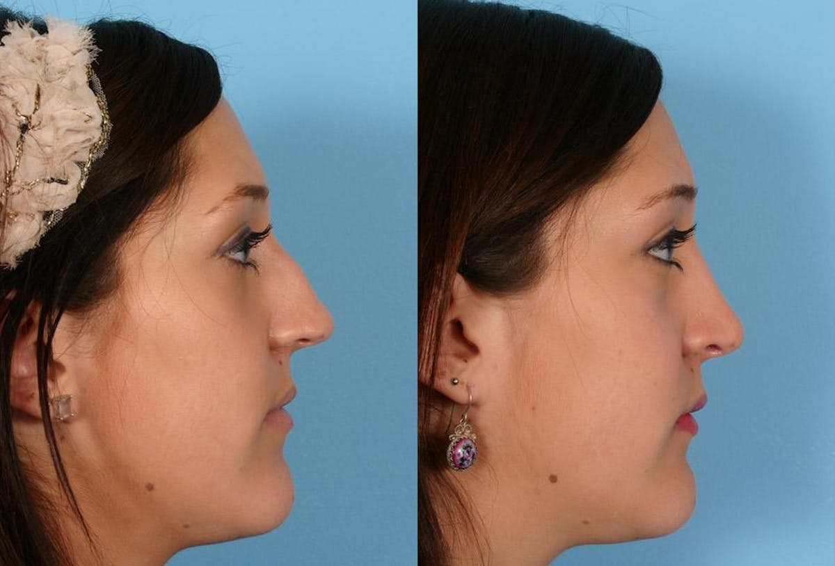 Nasal Obstruction Before & After Gallery - Patient 126630 - Image 2