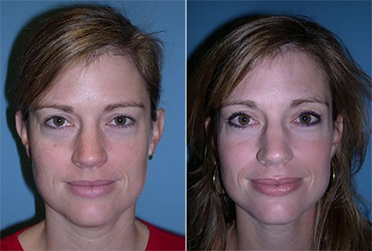 Eyelid Surgery (Blepharoplasty) Before & After Gallery - Patient 102441 - Image 1