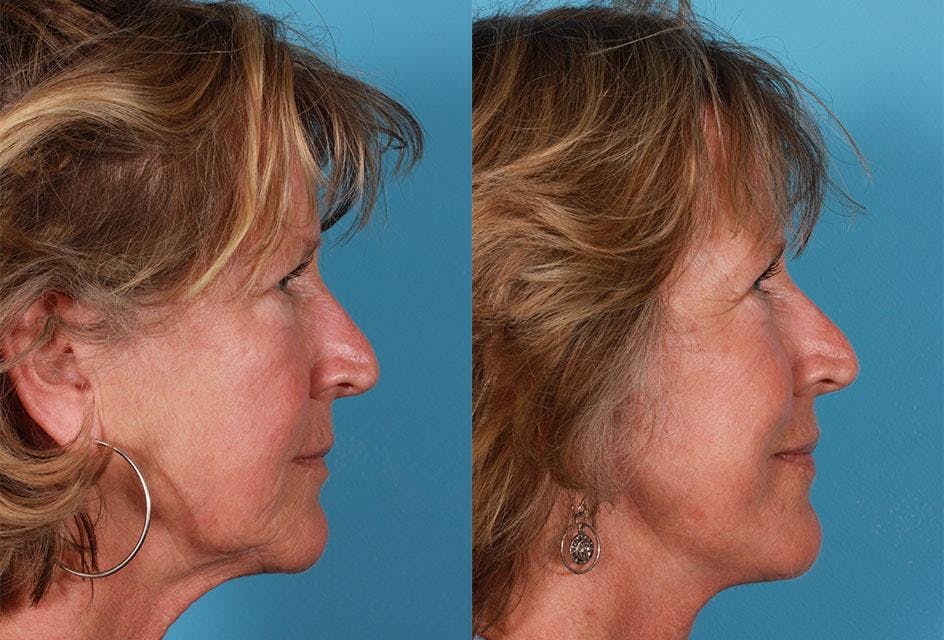 Limited Incision Facelift Before & After Gallery - Patient 130114 - Image 3