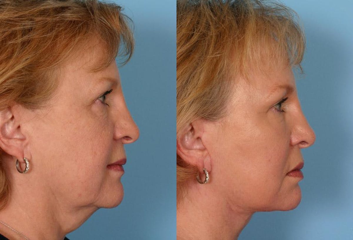 Facelift Before & After Gallery - Patient 111275 - Image 3