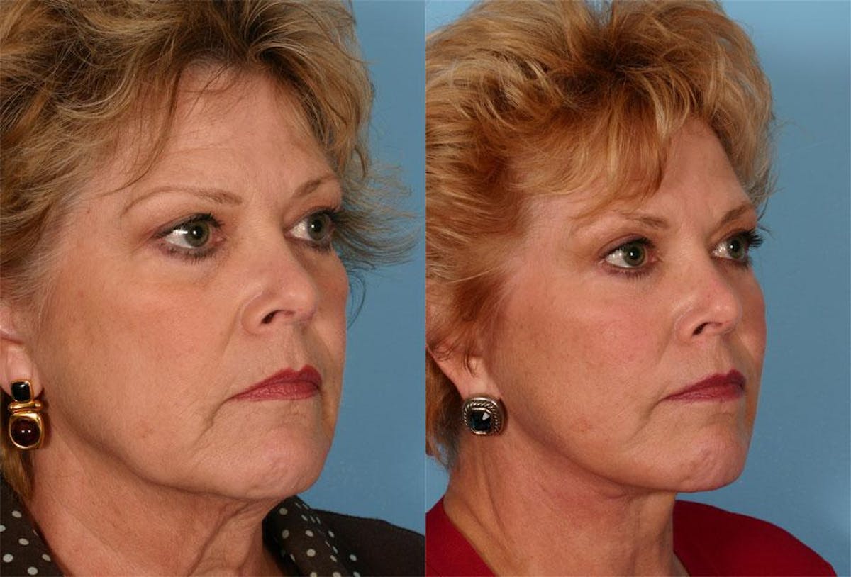 Facial Fat Transfer Before & After Gallery - Patient 408084 - Image 2