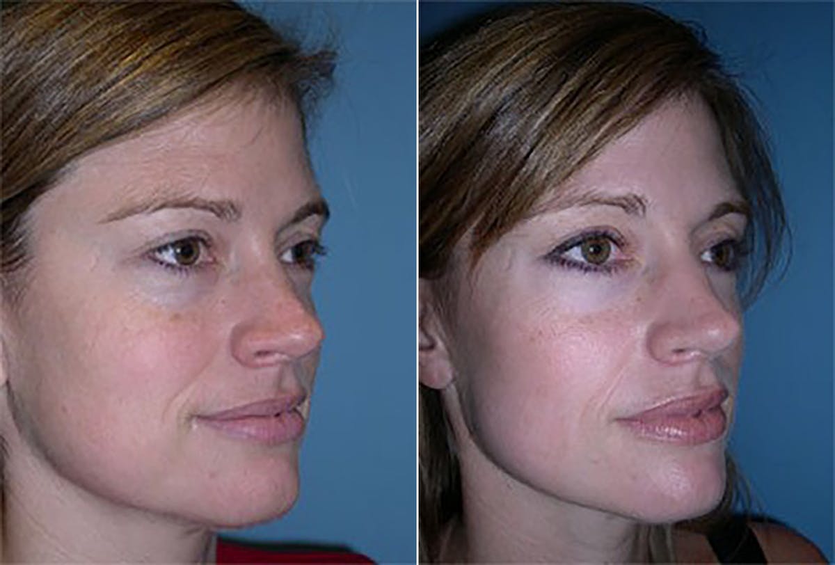 Eyelid Surgery (Blepharoplasty) Before & After Gallery - Patient 102441 - Image 2