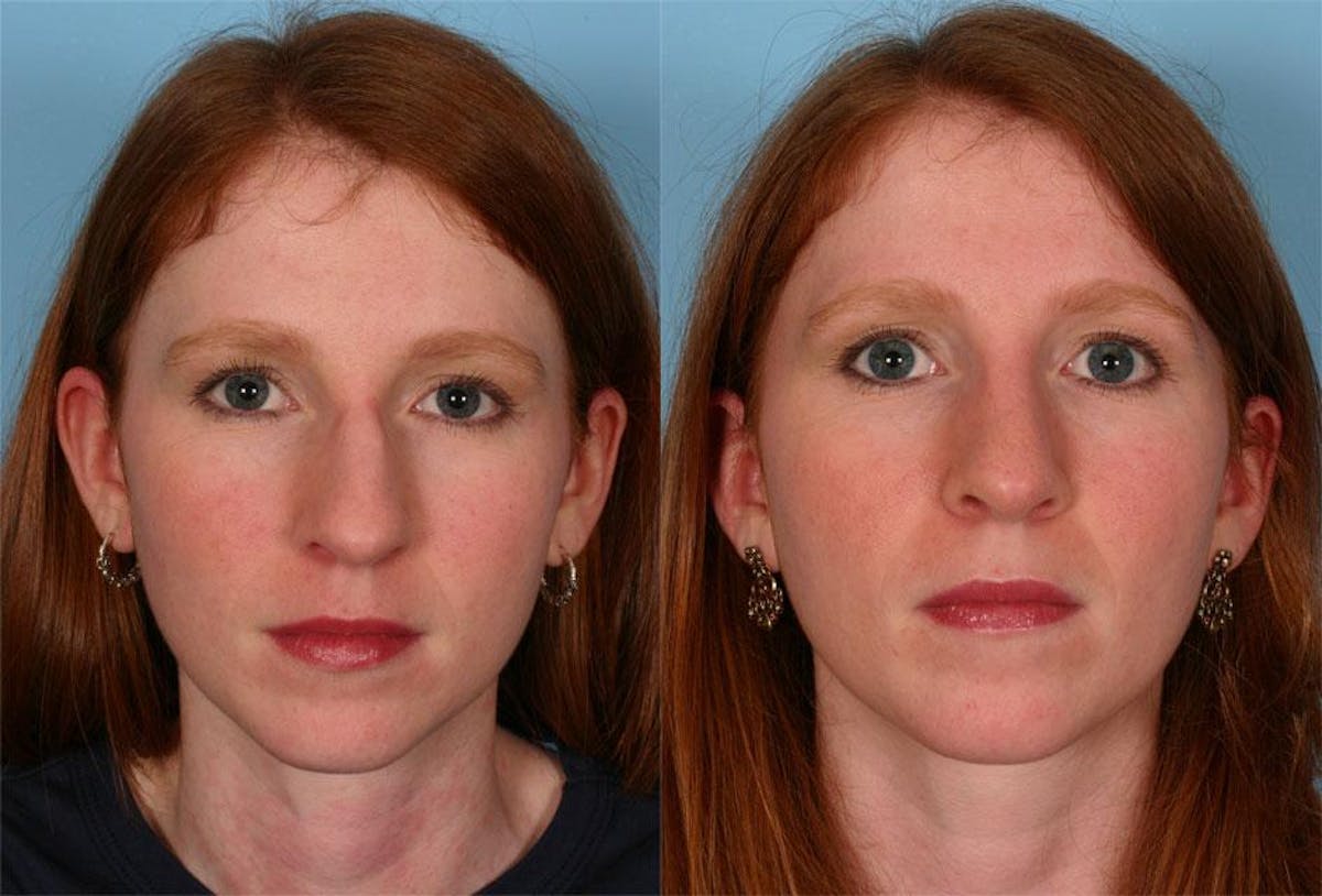 Rhinoplasty Before & After Gallery - Patient 100922 - Image 1