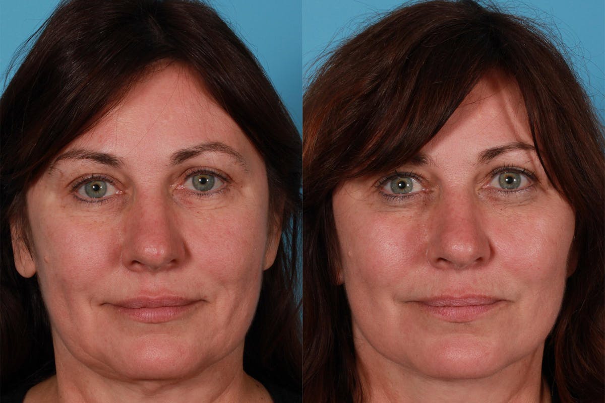 Limited Incision Facelift Before & After Gallery - Patient 218803 - Image 1